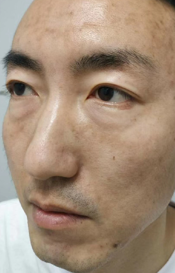 去眼袋手术