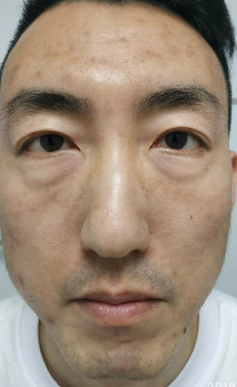 去眼袋手术