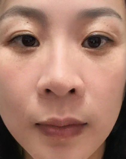 去眼袋手术