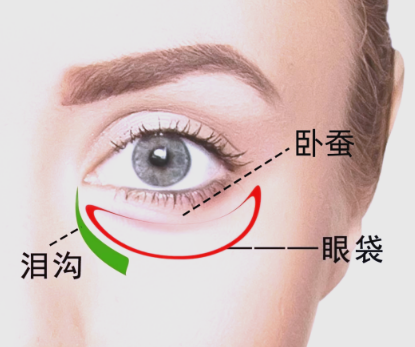 去眼袋手术