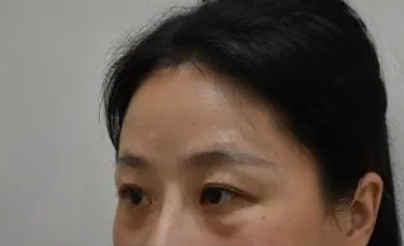 去眼袋手术