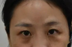 去眼袋手术