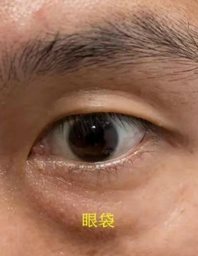 去眼袋手术