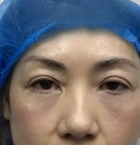 去眼袋手术