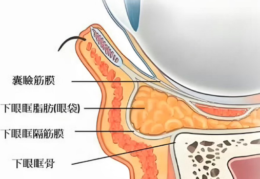 去眼袋手术