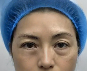去眼袋手术
