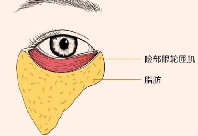 去眼袋手术