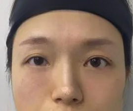 去眼袋手术