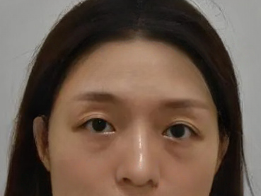 去眼袋手术
