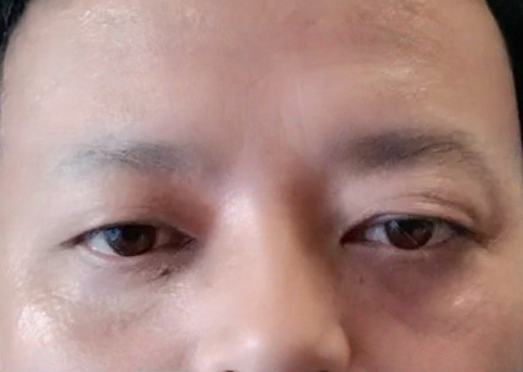 眼袋