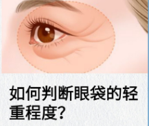 去眼袋手术