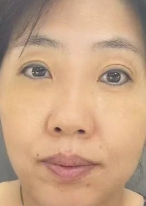 去眼袋手术