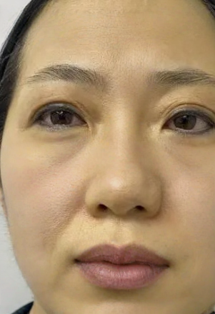 去眼袋手术