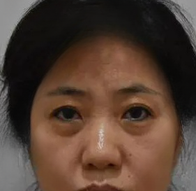 去眼袋手术