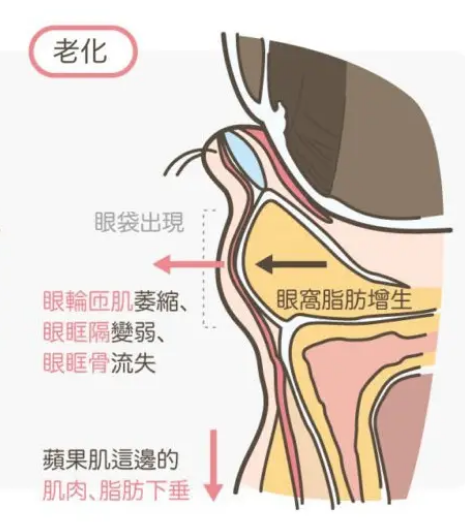 眼袋