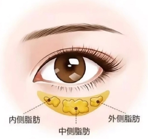 眼袋