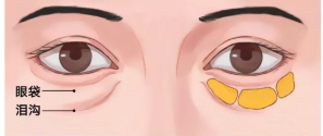 眼袋