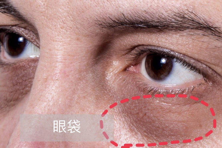 眼袋