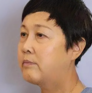 眼袋