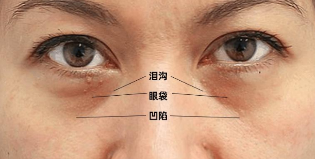眼袋