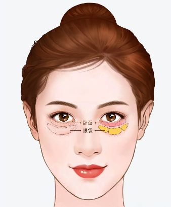 眼袋