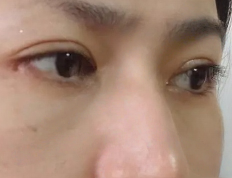 眼袋