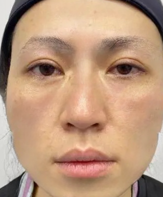 眼袋
