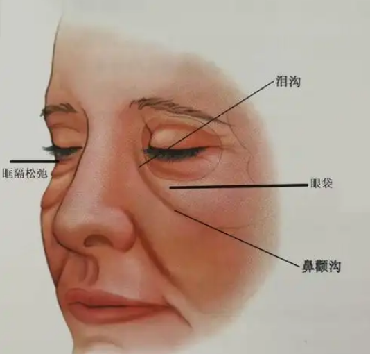 眼袋