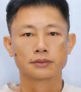 去眼袋手术