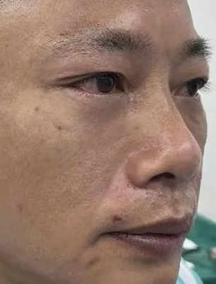 去眼袋手术