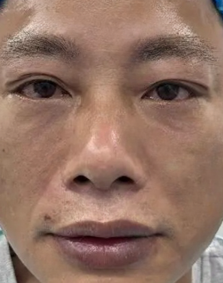 去眼袋手术