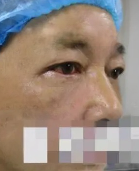 眼袋