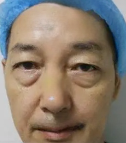 眼袋