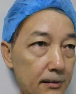 眼袋