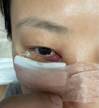 眼袋
