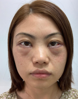 眼袋