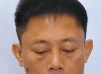 去眼袋手术