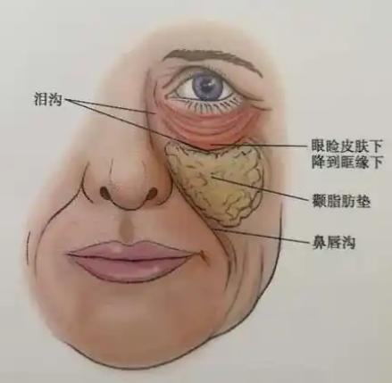 去眼袋手术