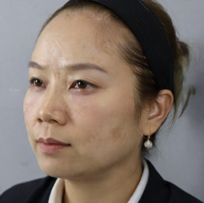 去眼袋手术