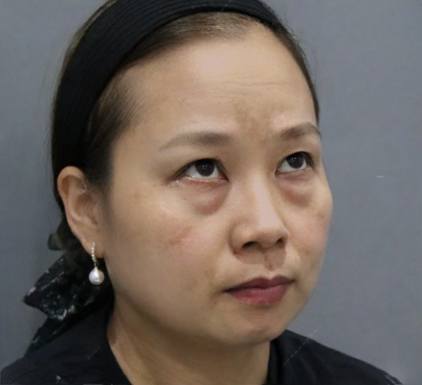 去眼袋手术