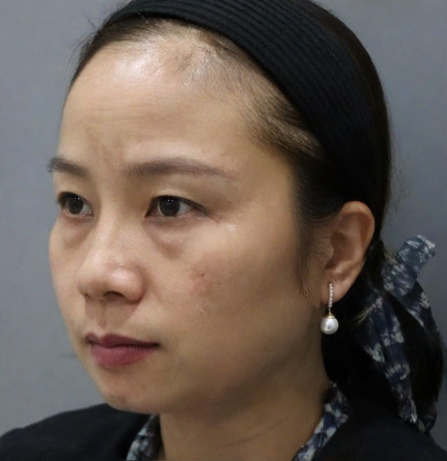 去眼袋手术