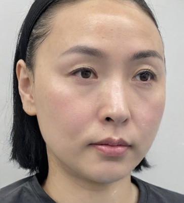 去眼袋手术