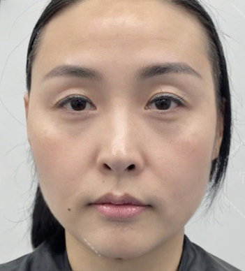 去眼袋手术