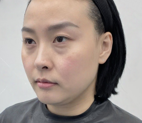 去眼袋手术