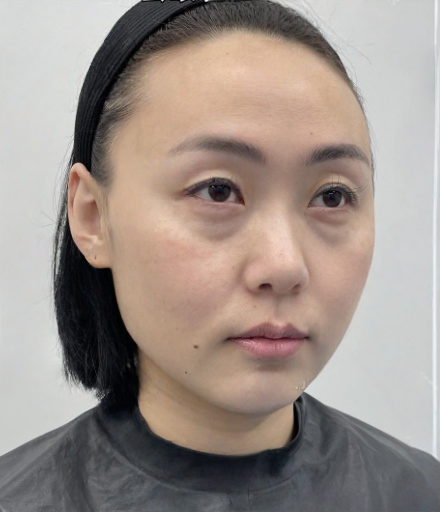 去眼袋手术