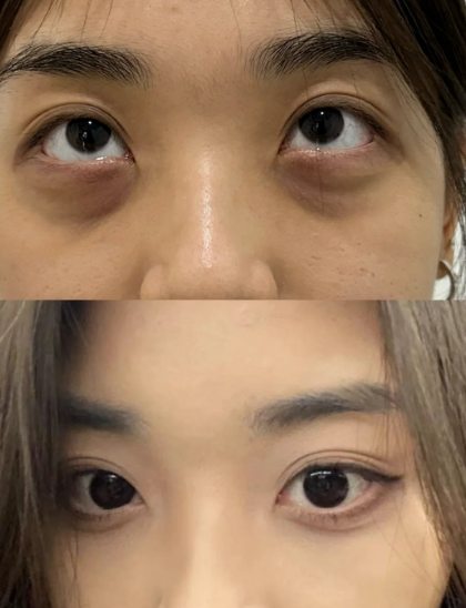 去眼袋手术