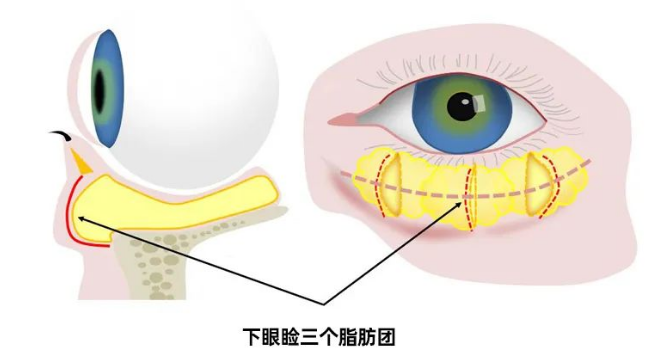 去眼袋手术