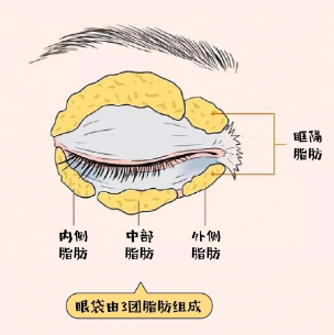 去眼袋手术