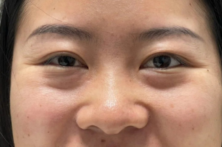 去眼袋手术