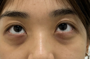 去眼袋手术